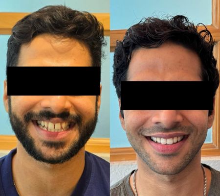 Before & After Transformation 4
