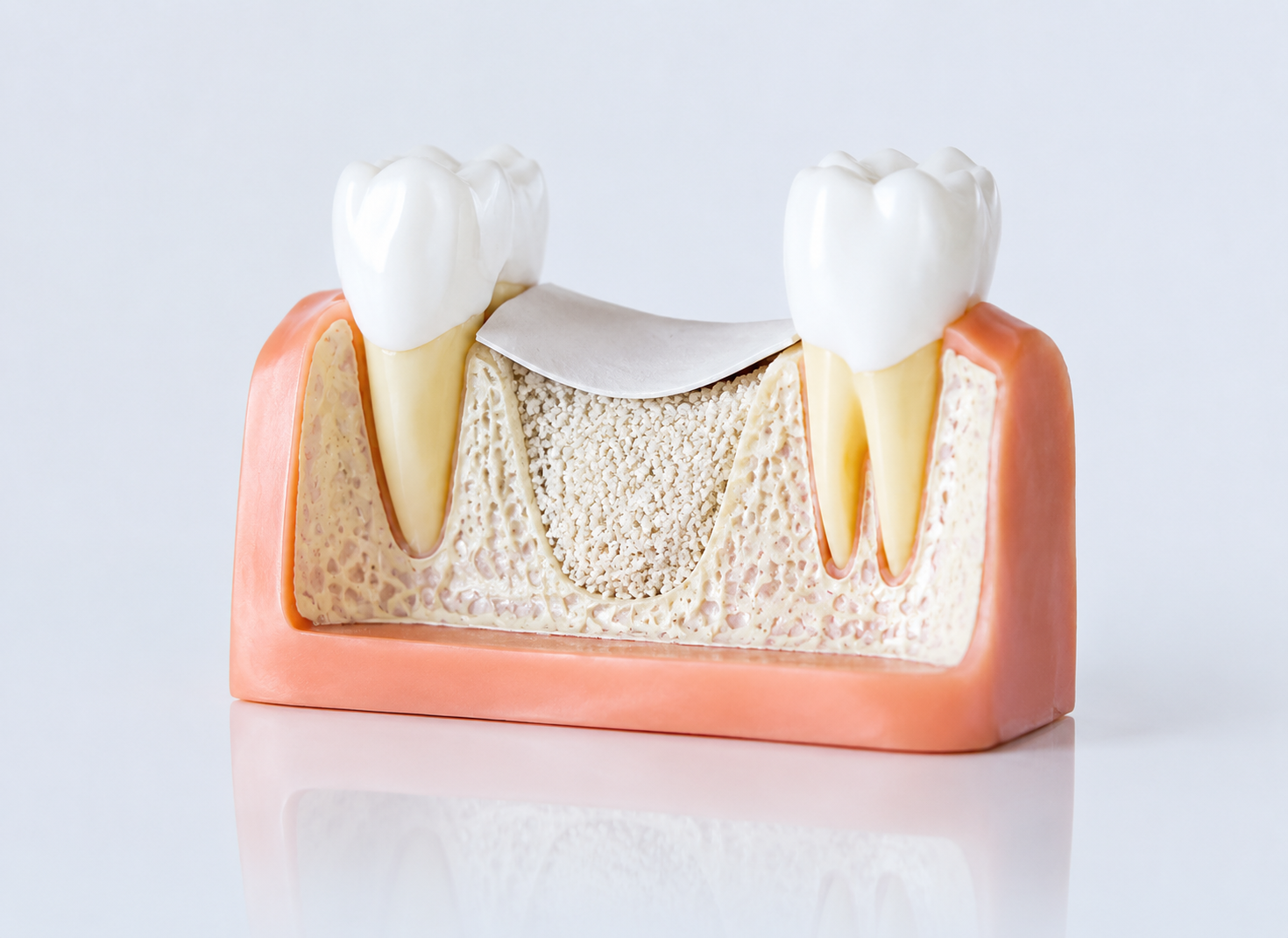 Bone Grafting Procedures in Bandra Mumbai