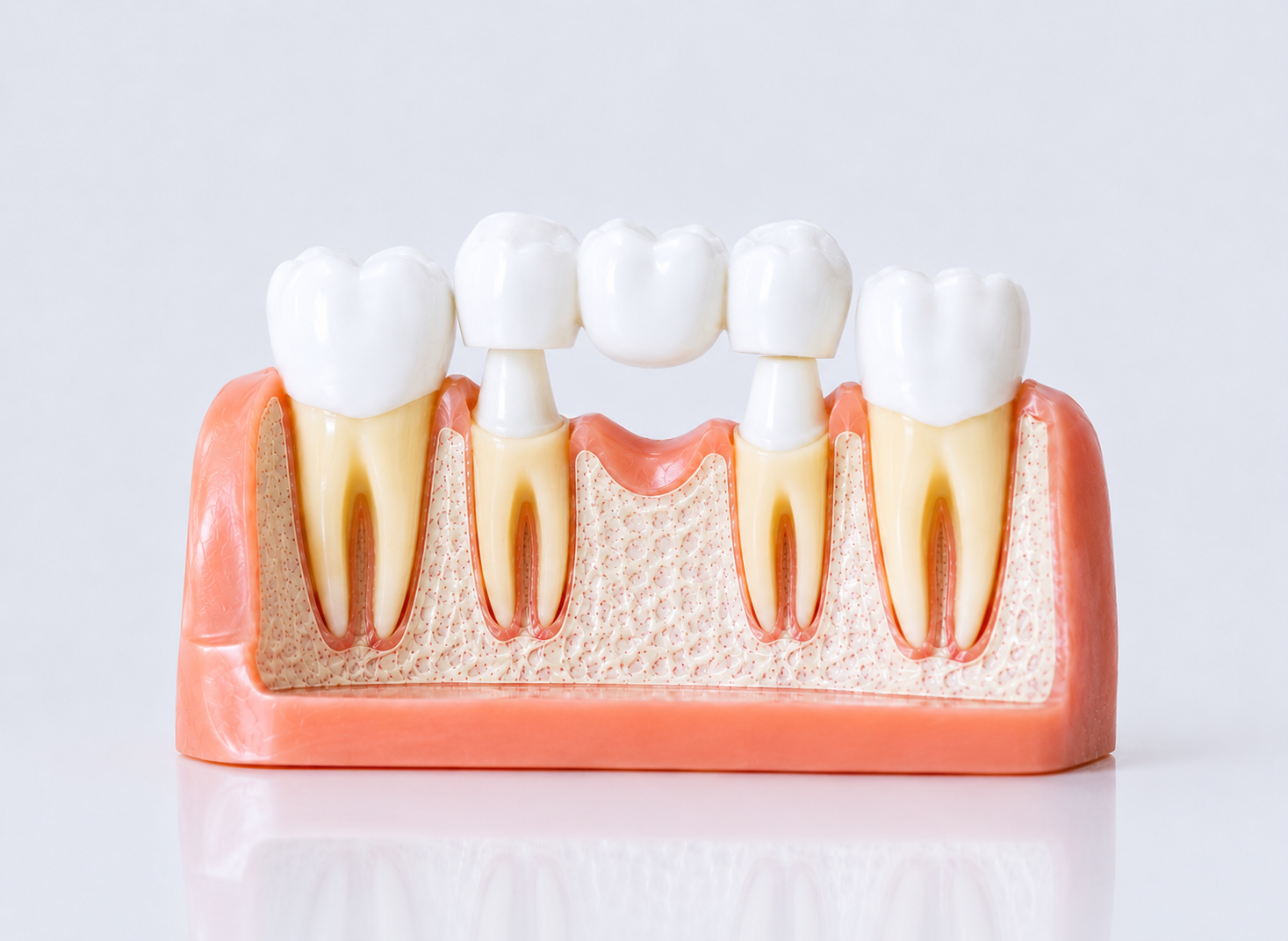 Best Crowns and Bridges Clinic in Bandra Mumbai