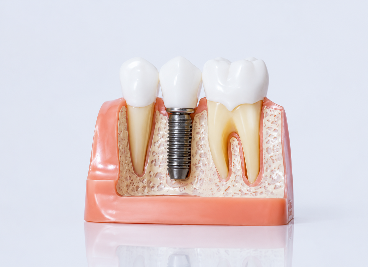 Dental Implants – Dr. Devanand Shetty, Bandra Mumbai