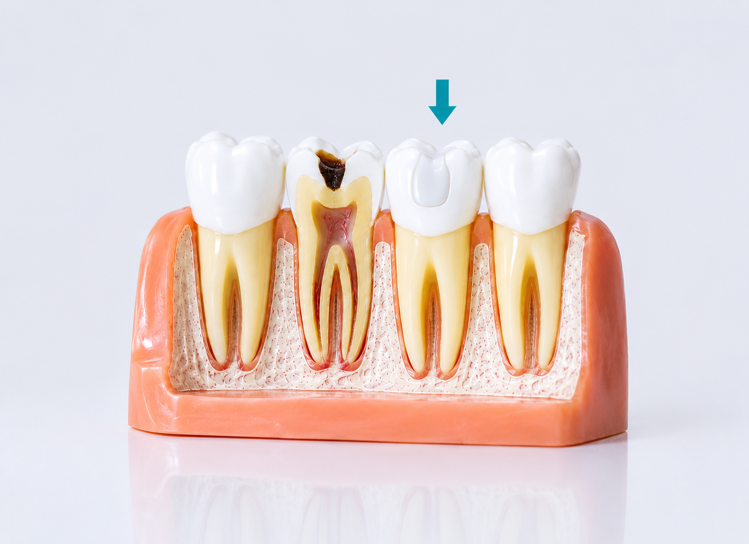 Best Dental Fillings Clinic in Bandra Mumbai