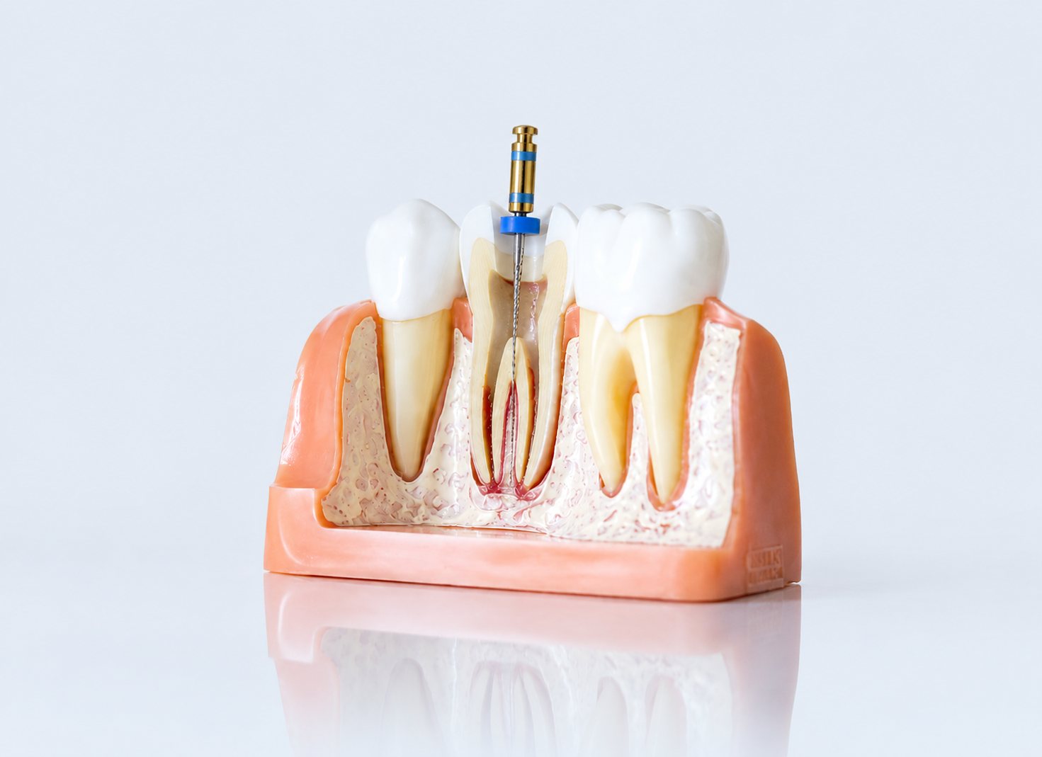 Root Canal Treatment – Dr. Devanand Shetty, Bandra Mumbai