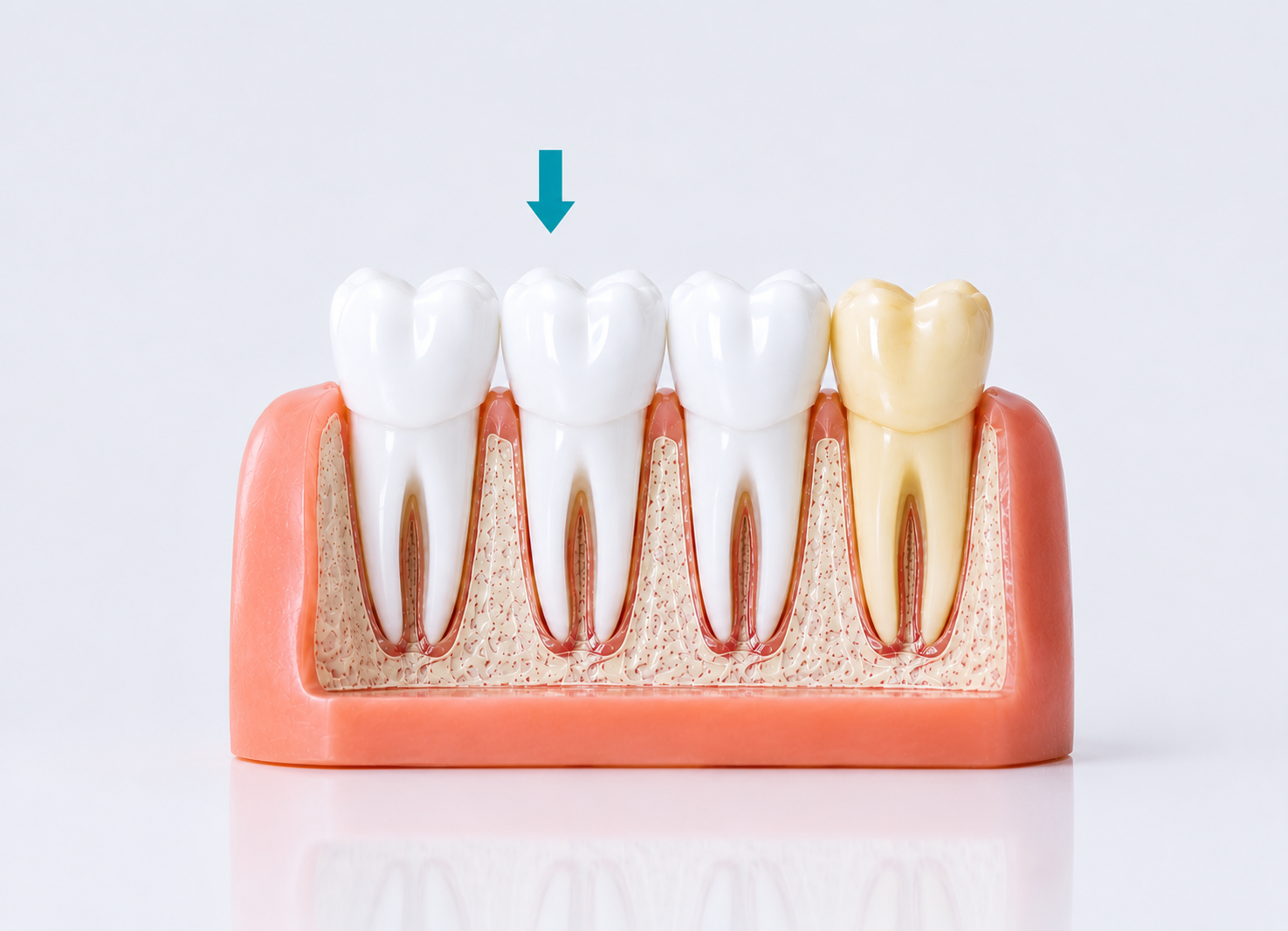 Professional Teeth Whitening Treatment – Dr. Devanand Shetty, Bandra Mumbai